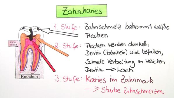 Bakterien als Krankheitserreger – Zahnkaries
